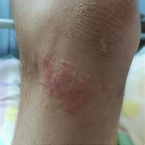 ����hpv���ڵ���ɫ����ͼƬ����
