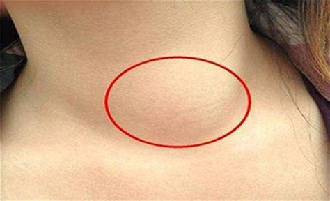 Ҹ���ܰͽ��״�ͼƬ���״�֢״�Լ��γ�ԭ��(ϸ����Ⱦ������)