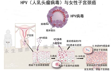 Ů������hpv��ȾͼƬ��hpv��Ⱦ������֢״ͼ��